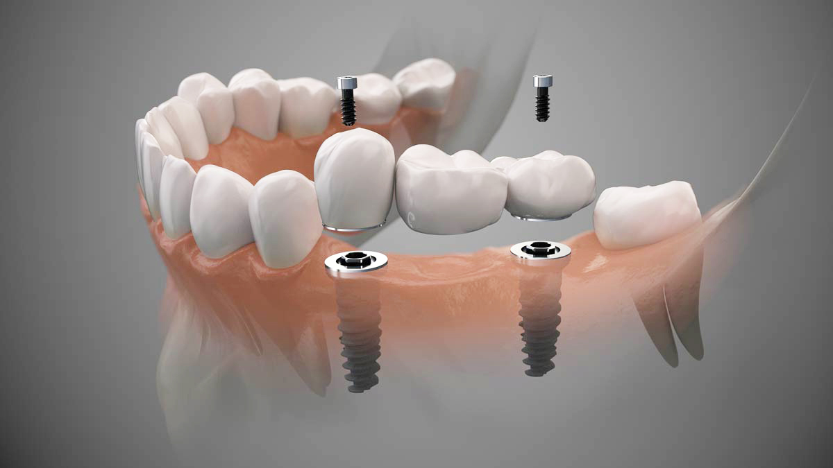sustitución de varios dientes