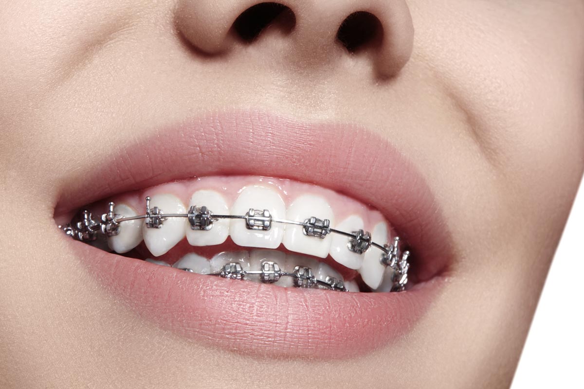 Cómo se colocan implantes dentales